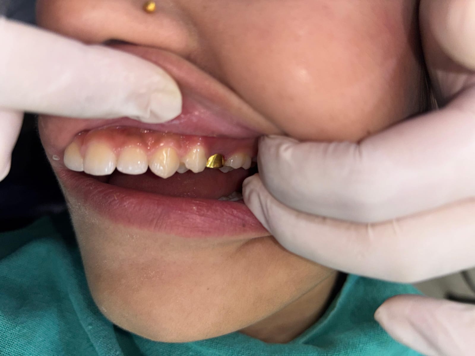 Dental Crowns (Zirconia, PFM, Metal & Gold)