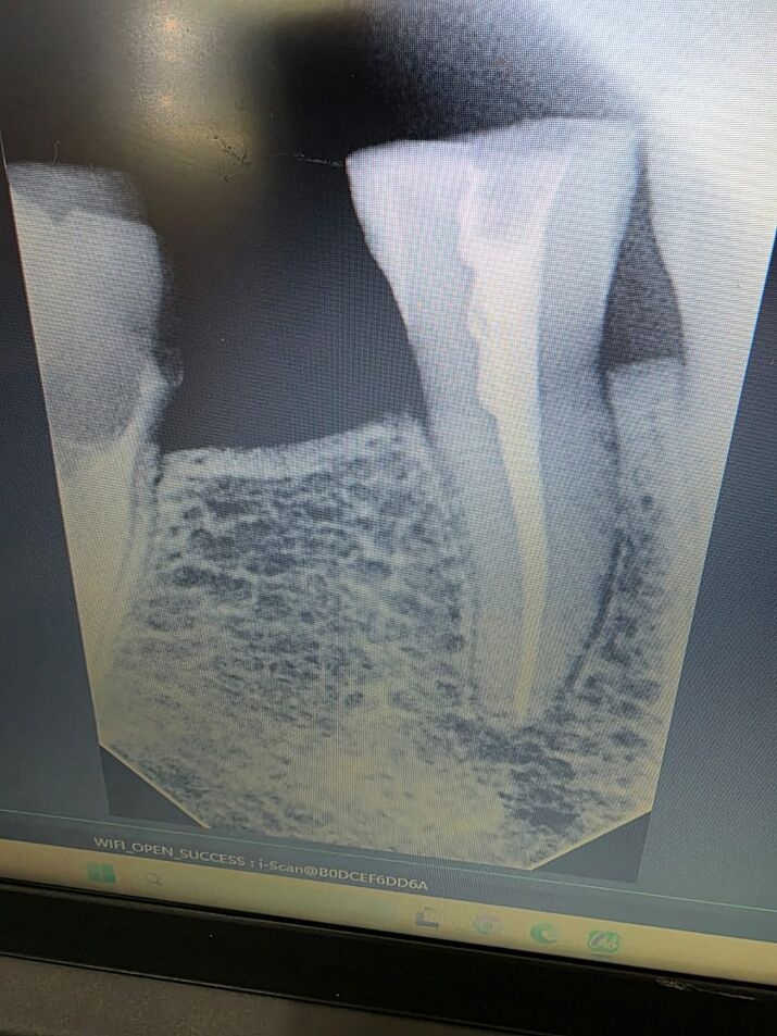 Dental X-Ray