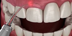 Gingival Surgery