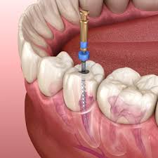 Root Canal Treatment (RCT)