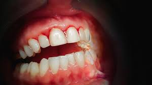 Bleeding Gums Treatment