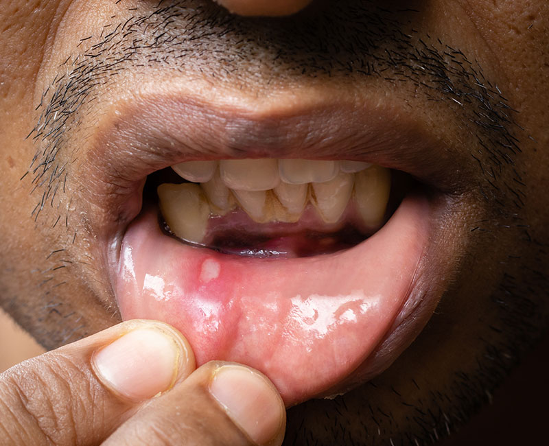 Treatment of Oral Lesions