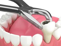 Simple Tooth Extraction