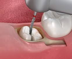 Surgical Tooth Extraction